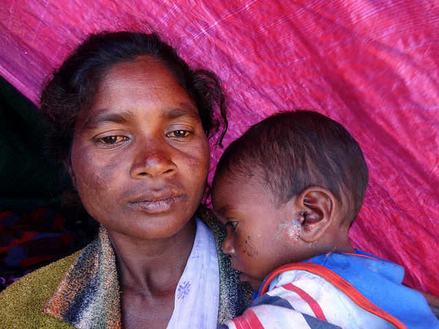 Este niño, residente del campamento Serfanguri, padece una infección de la piel. Su madre dice que aún no ha recibido medicamentos de la Misión Nacional de Salud Rural. Crédito: Priyanka Borpujari/IPS