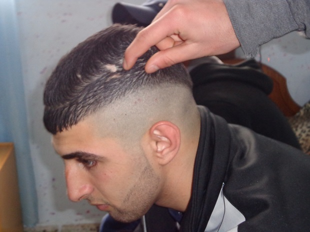 A Ahmed Othman Safi, de 17 años, le quedó una cicatriz luego de que soldados israelíes le fracturaran el cráneo con la culata de sus armas durante su arresto. Crédito: Mel Frykberg/IPS