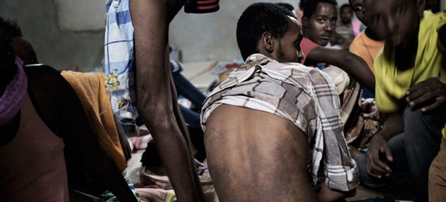 Un migrante de Eritrea muestra las enfermedades de la piel que contrajo en un centro de detención de Libia. Crédito: Alessio Romenzi/Unicef