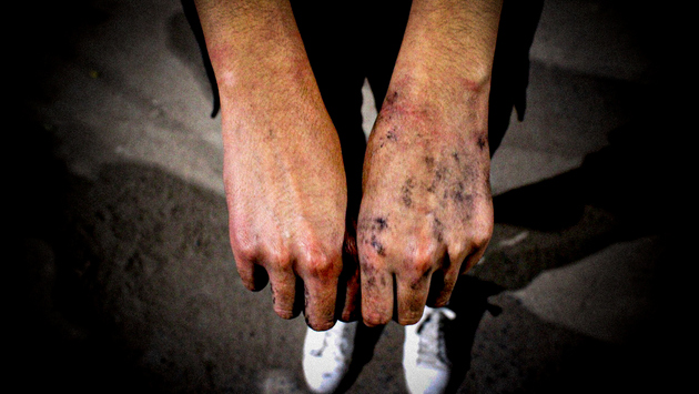 Un manifestante muestra los efectos en sus manos de la violencia policial. Foto: Félix Márquez/IPS